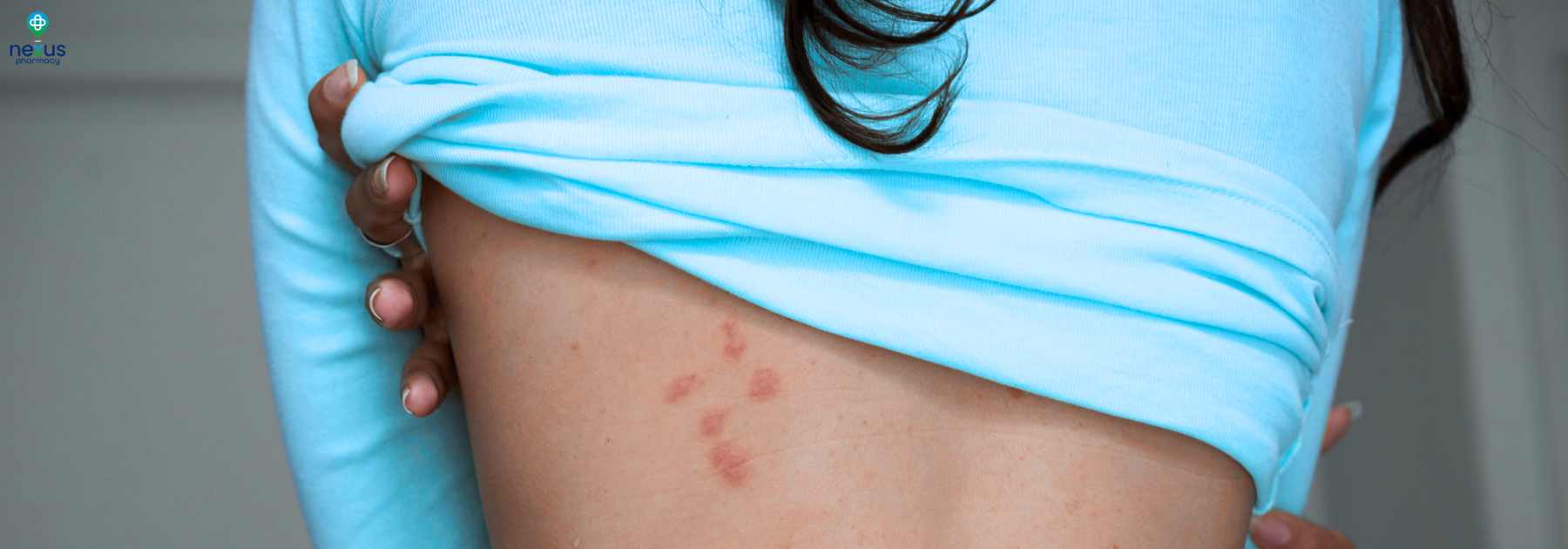 treatment for infected insect bites nottingham
